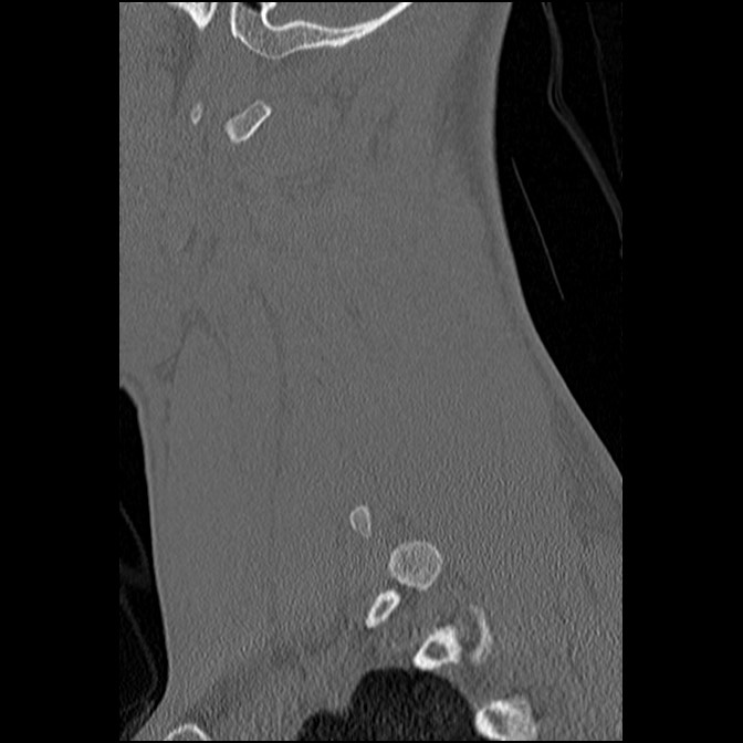 C5 facet fracture (Radiopaedia 58374-65499 Sagittal bone window 20).jpg