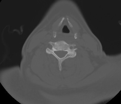 C7 laminar fracture and Klippel-Feil syndrome (Radiopaedia 86710-102850 Axial bone window 46).jpg