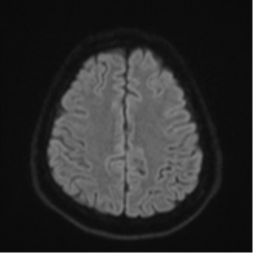 File:CNS vasculitis (Radiopaedia 55715-62263 Axial DWI 51).png