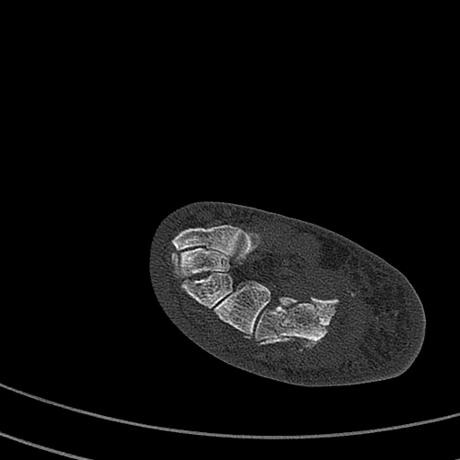 Calcaneal fracture - Sanders type 4 (Radiopaedia 90179-107370 Axial bone window 39).jpg