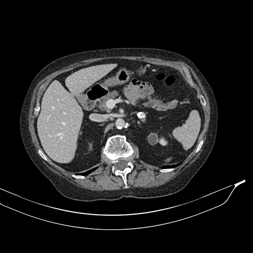 Calcified adrenal glands and Spigelian hernia (Radiopaedia 49741-54988 A 66).jpg