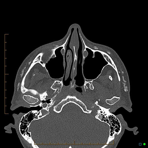 Calcified facial augmentation fillers (Radiopaedia 79514-92679 Axial bone window 19).jpg