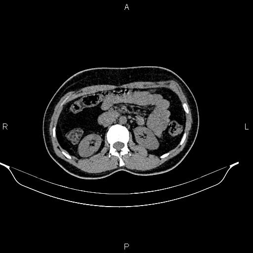 File:Calcified hepatic hydatid cyst (Radiopaedia 84672-100095 Axial non-contrast 45).jpg