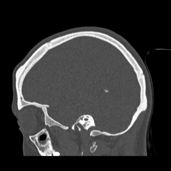 Calvarial osteoma (Radiopaedia 36520-38079 Sagittal bone window 36).jpg
