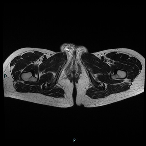 File:Canal of Nuck cyst (Radiopaedia 55074-61448 Axial T2 24).jpg