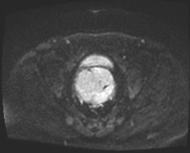 Cancer cervix - stage IIb (Radiopaedia 75411-86615 Axial DWI 43).jpg