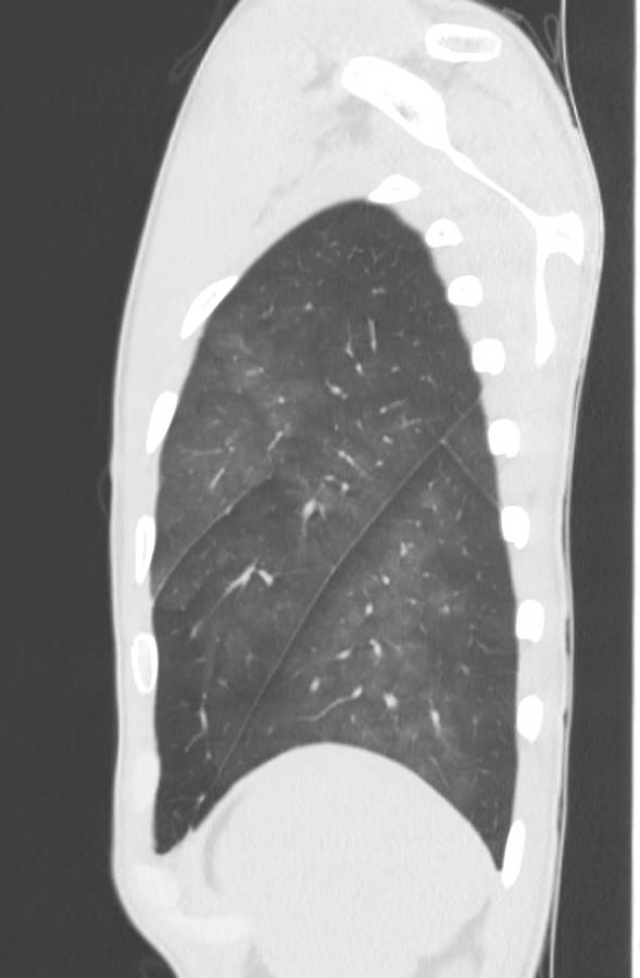 Cannabis-induced diffuse alveolar hemorrhage (Radiopaedia 89834-106946 Sagittal lung window 121).jpg