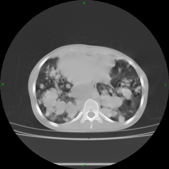 File:Cannon ball metastases - synovial sarcoma (Radiopaedia 26135-26271 Axial lung window 28).jpg