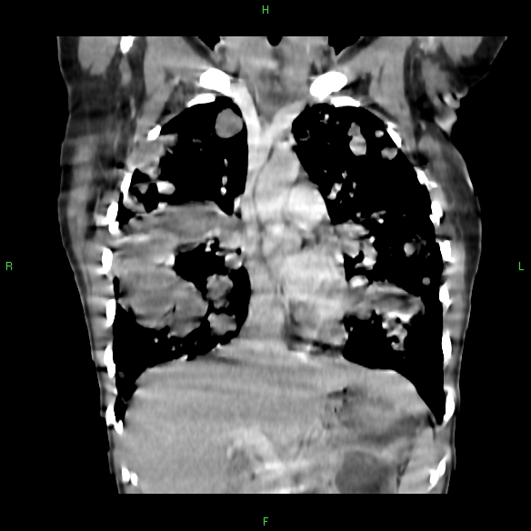 File:Cannon ball metastases - synovial sarcoma (Radiopaedia 26135-26271 Coronal liver window 6).jpg