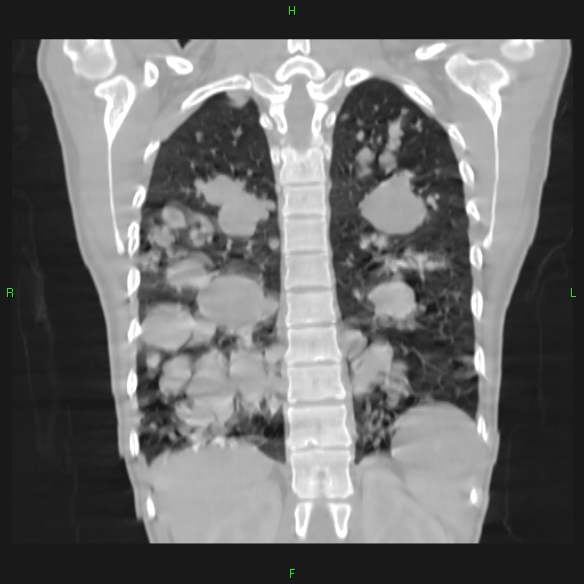 File:Cannon ball metastases - synovial sarcoma (Radiopaedia 26135-26271 Coronal lung window 16).jpg