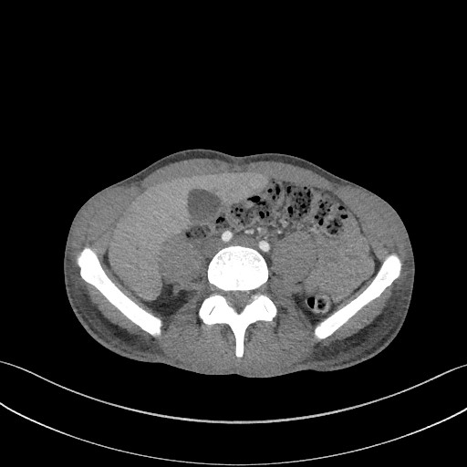 Cannonball metastases - testicular choriocarcinoma (Radiopaedia 84510-99891 B 151).jpg