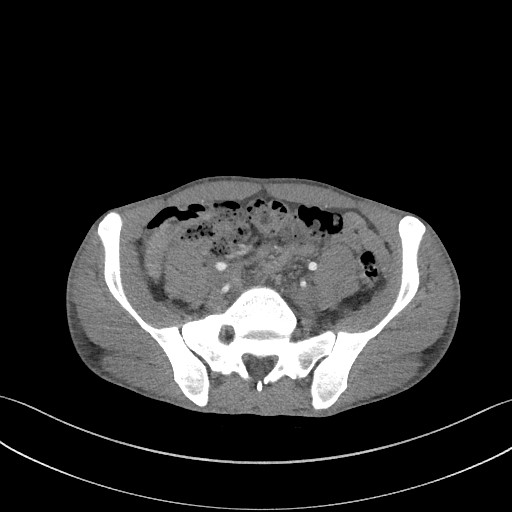 Cannonball metastases - testicular choriocarcinoma (Radiopaedia 84510-99891 B 163).jpg