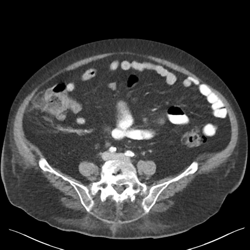 Cannonball metastases from endometrial cancer (Radiopaedia 42003-45031 E 50).png