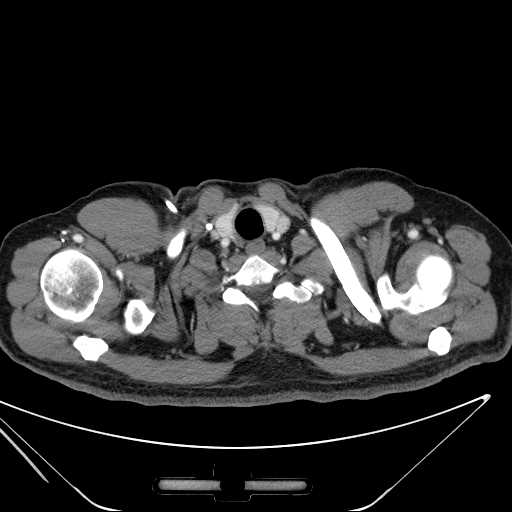 File:Cannonball pulmonary metastases (Radiopaedia 67684-77101 D 1).jpg