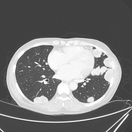 Canonball lung metastasis (Radiopaedia 77634-89837 Axial lung window 110).jpg