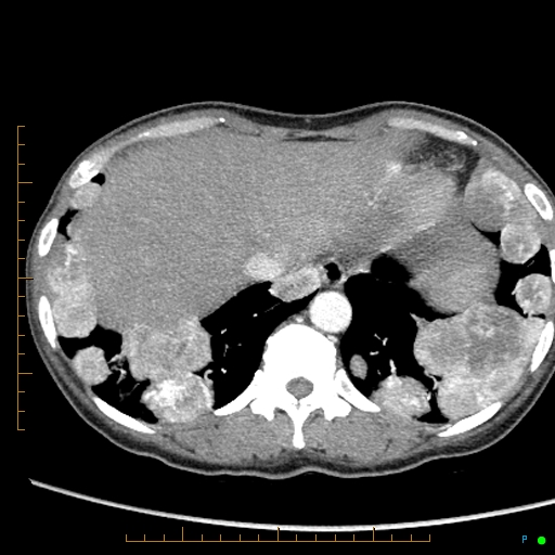 Canonball lung metastasis (Radiopaedia 77634-89837 B 85).jpg