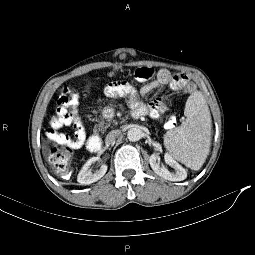 Caput medusae sign - portal hypertension (Radiopaedia 64007-72759 A 35).jpg