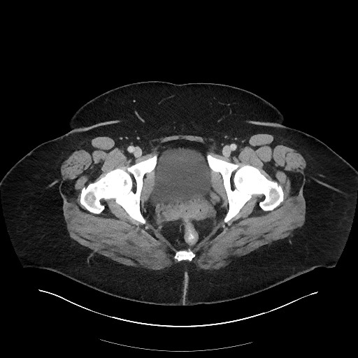 File:Carcinoid tumor - terminal ileum (Radiopaedia 60931-68739 A 132).jpg