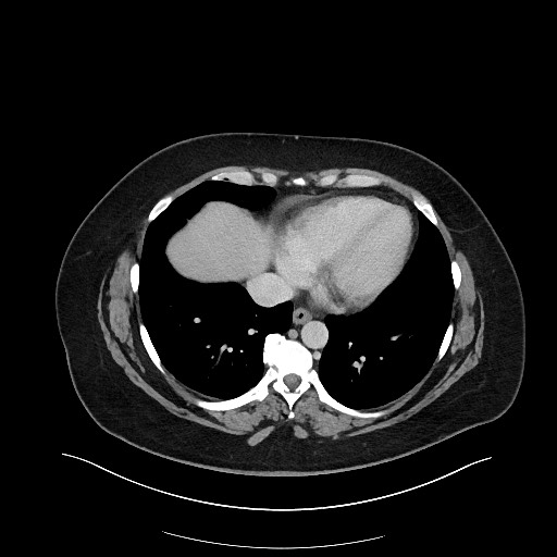 Carcinoid tumor - terminal ileum (Radiopaedia 60931-68739 A 9).jpg