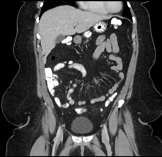 Carcinoid tumor - terminal ileum (Radiopaedia 60931-68739 B 22).jpg
