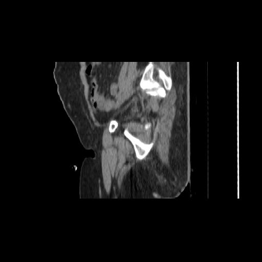 File:Carcinoma cervix- brachytherapy applicator (Radiopaedia 33135-34173 D 39).jpg