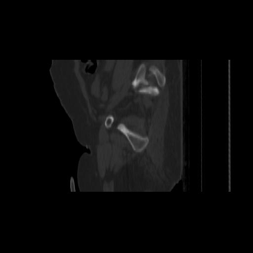 Carcinoma cervix- brachytherapy applicator (Radiopaedia 33135-34173 Sagittal bone window 147).jpg