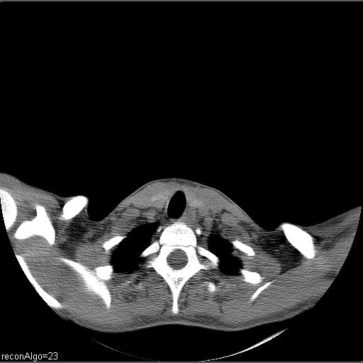 File:Carcinoma of the maxillary antrum (Radiopaedia 53805-59888 Axial non-contrast 8).jpg