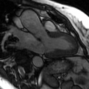 File:Cardiac MRI - standard imaging planes (Radiopaedia 14225-14090 3-chamber view 9).jpg