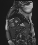 Cardiac amyloidosis (Radiopaedia 51404-57150 Sagittal CINE SSFP 134).jpg