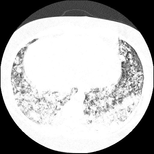 Cardiac angiosarcoma (Radiopaedia 66010-75181 Axial lung window 13).jpg