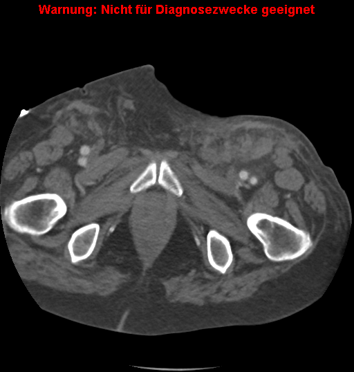 File:Cardiac perforation following transcatheter aortic valve implantation (Radiopaedia 23714-23863 B 14).png