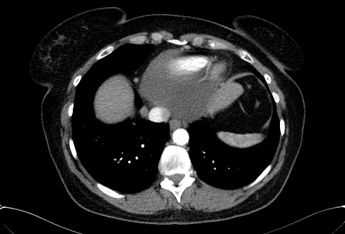 Cardiac sarcoidosis (Radiopaedia 74548-85534 A 70).jpg