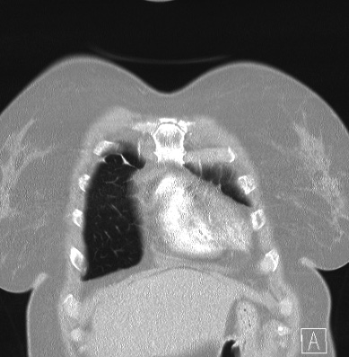 File:Cardiac sarcoidosis (Radiopaedia 74548-85534 Coronal lung window 6).jpg