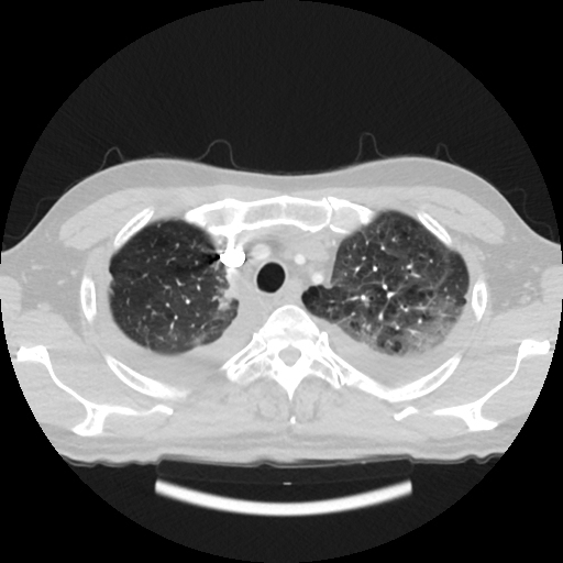 File:Cardiac tamponade (Radiopaedia 78607-91368 Axial lung window 11).jpg