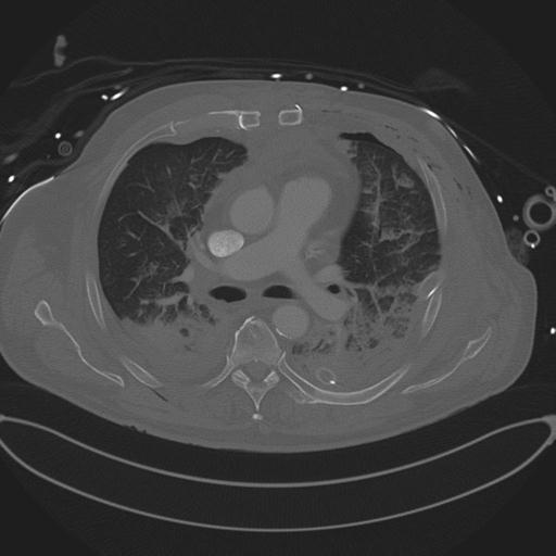 Cardiac trauma (Radiopaedia 32874-33858 Axial bone window 39).jpg