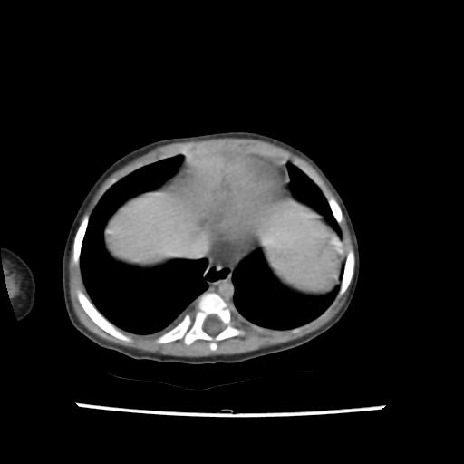 Caroli disease with autosomal recessive polycystic kidney disease (ARPKD) (Radiopaedia 89651-106703 B 14).jpg