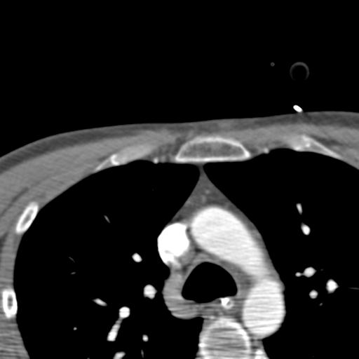 File:Carotid arterial dissection (Radiopaedia 30001-30548 B 2).jpg