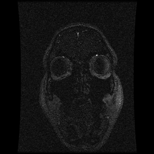 Carotid arterial dissection with acute cerebral infarction (Radiopaedia 26636-26784 MRV 139).jpg