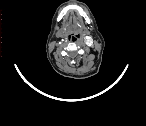 Carotid body tumor (Radiopaedia 66785-76116 B 40).jpg