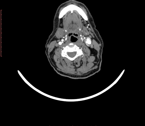 Carotid body tumor (Radiopaedia 66785-76116 B 48).jpg