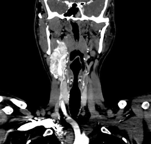 File:Carotid body tumor (Radiopaedia 83615-98727 B 56).jpg
