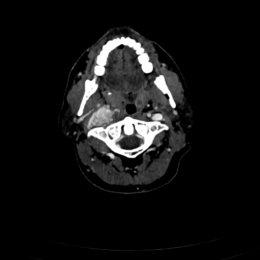 Carotid body tumor (Radiopaedia 83615-98727 D 41).jpg
