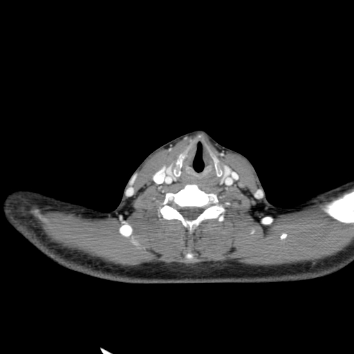 Carotid bulb pseudoaneurysm (Radiopaedia 57670-64616 A 51).jpg