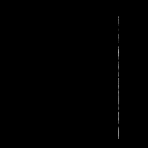 File:Carotid near-occlusion (Radiopaedia 85304-100887 B 2).jpg