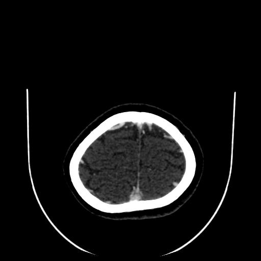 Cavernoma with developmental venous anomaly (Radiopaedia 22470-22506 C 180).jpg