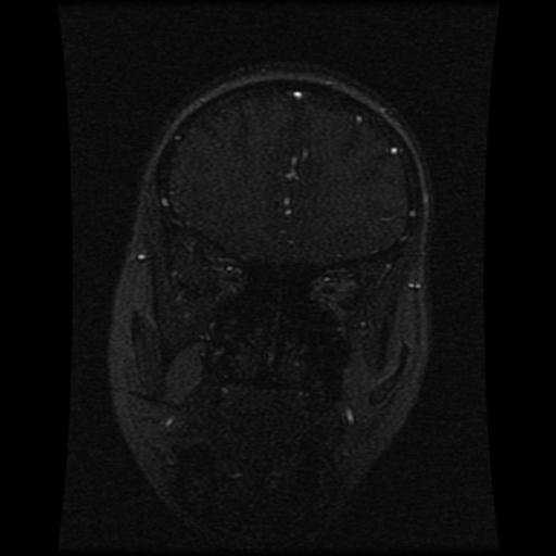 File:Cavernoma with developmental venous anomaly (Radiopaedia 22470-22507 MRV 97).jpg