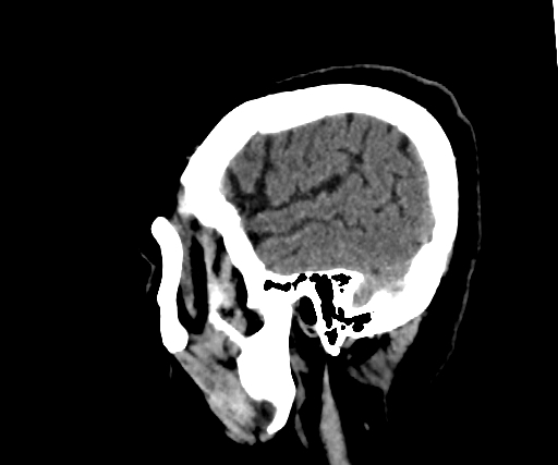 Cavernous hemangioma of the cerebellar falx (Radiopaedia 73025-83723 B 52).jpg