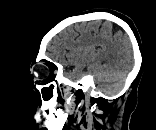 Cavernous hemangioma of the cerebellar falx (Radiopaedia 73025-83723 B 92).jpg