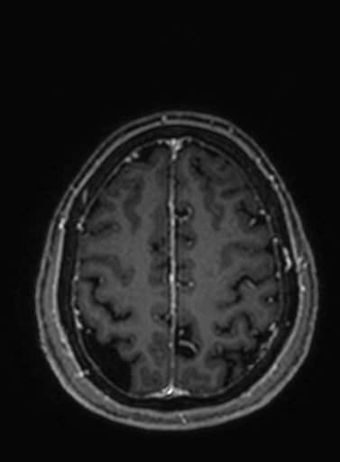 Cavernous hemangioma of the cerebellar falx (Radiopaedia 73025-83724 Axial T1 C+ 80).jpg