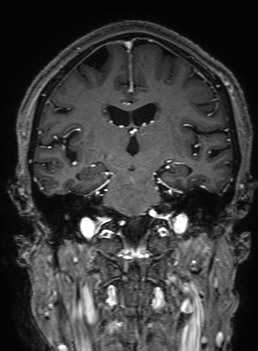 Cavernous hemangioma of the cerebellar falx (Radiopaedia 73025-83724 Coronal T1 C+ 203).jpg